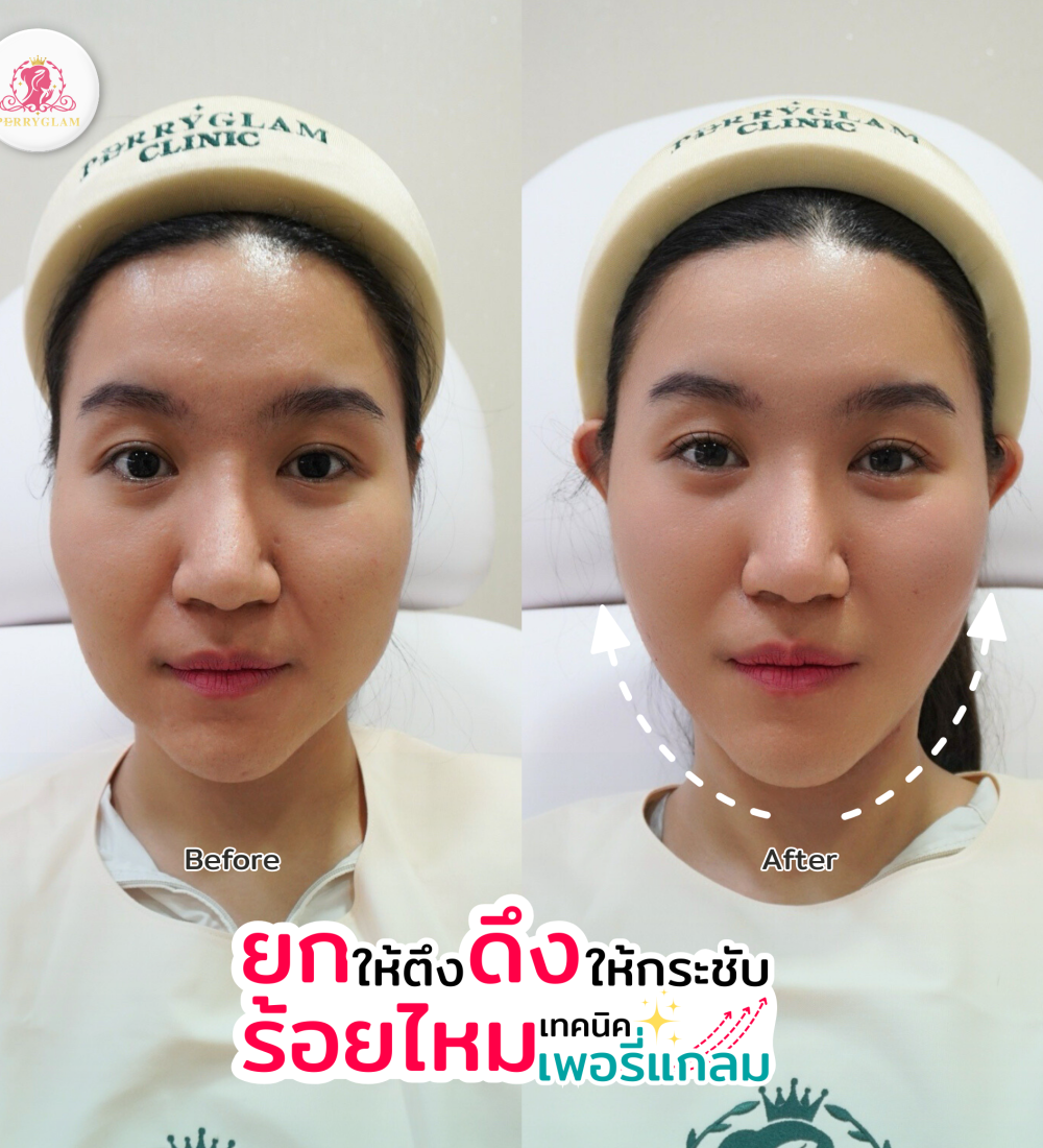 ยกให้ตึงดึงให้กระชับ ยกให้ตึงดึงให้กระชับ